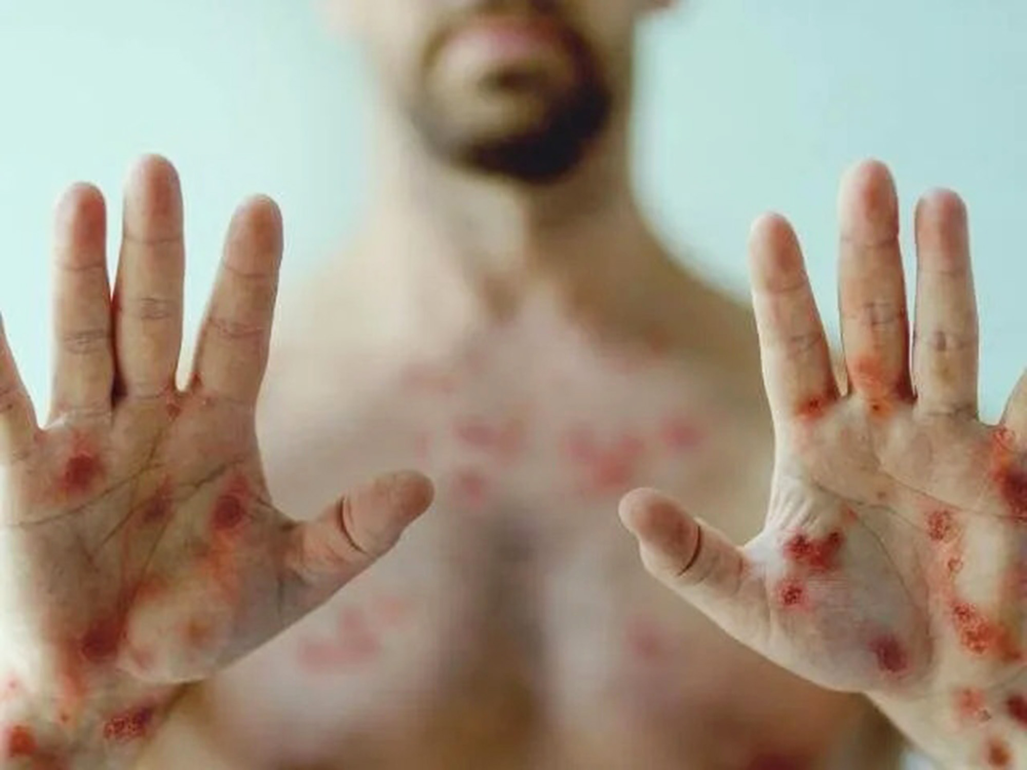 Ph&aacute;t hiện nam bệnh nh&acirc;n ở TP.HCM mắc bệnh đậu m&ugrave;a khỉ - Ảnh 1.