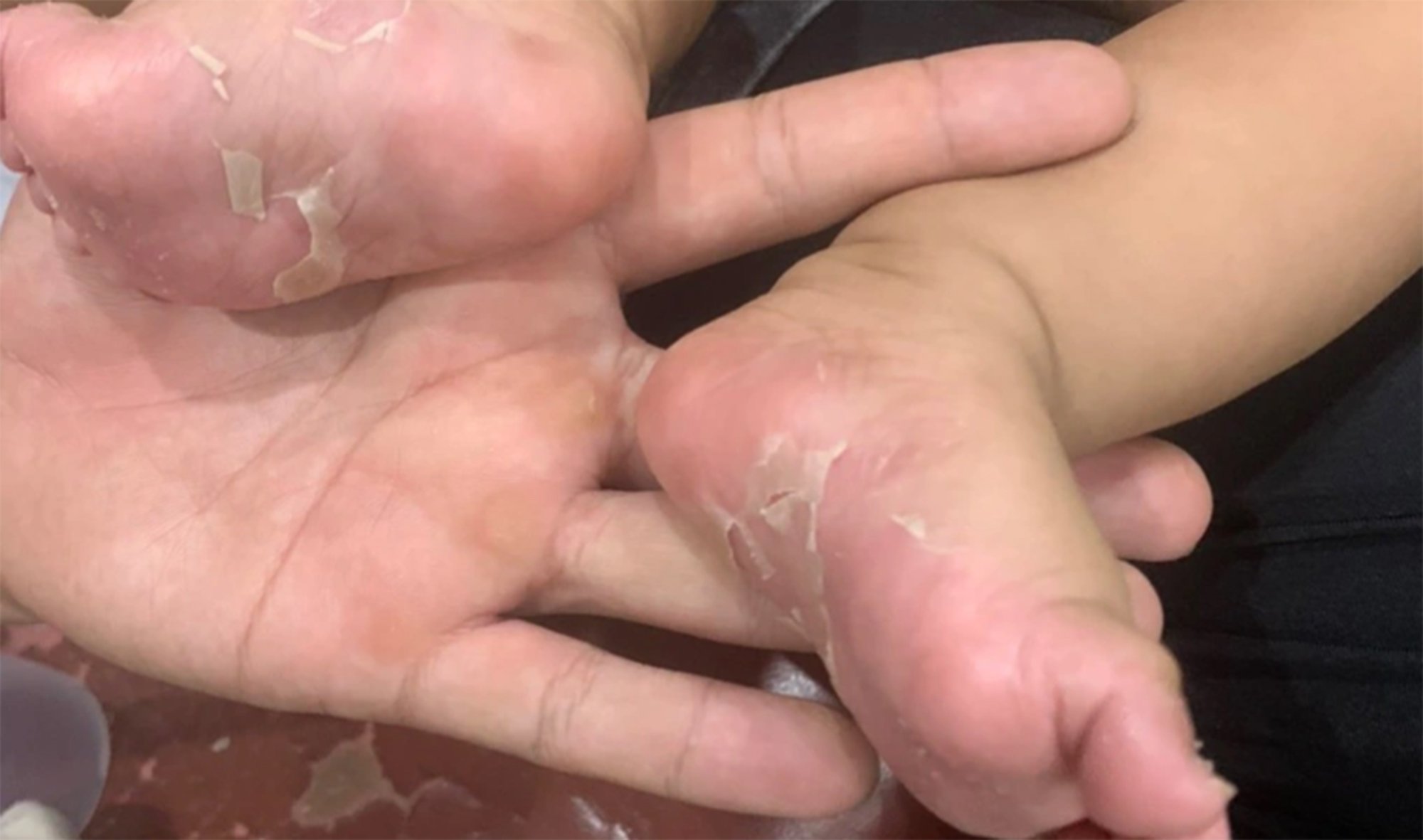 Vì sao trẻ sơ sinh cũng mắc bệnh giang mai? - Ảnh 1. Vì sao trẻ sơ sinh cũng mắc bệnh giang mai? - Ảnh 1.