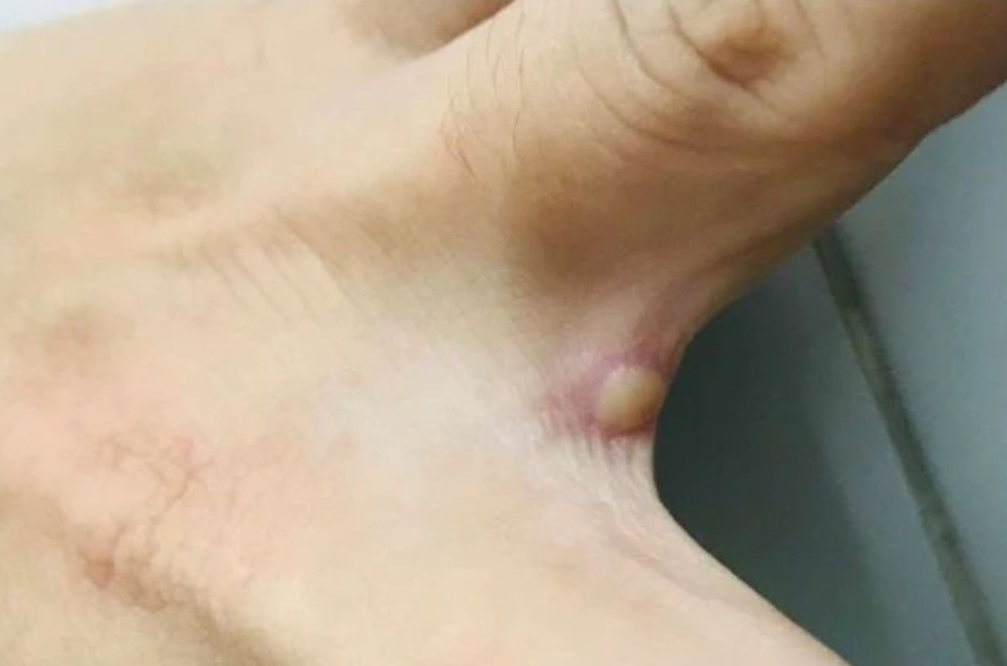 TP.HCM ghi nhận th&ecirc;m ca đậu m&ugrave;a khỉ thứ 5 ở quận T&acirc;n B&igrave;nh - Ảnh 1.