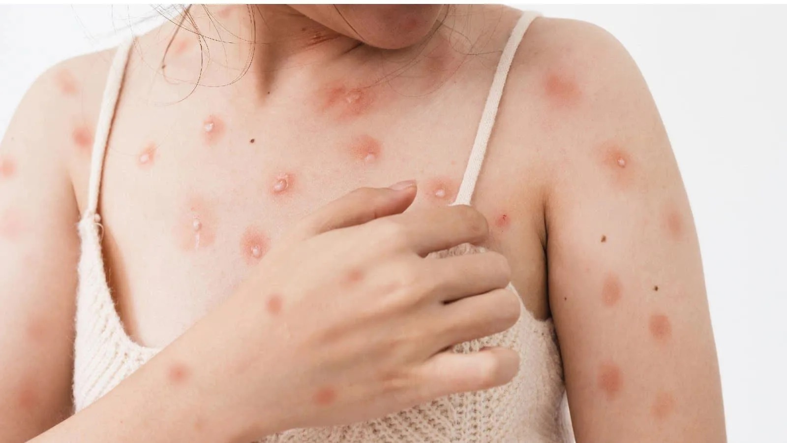 Diễn biến ca đậu m&ugrave;a khỉ đầu ti&ecirc;n ở Cần Thơ - Ảnh 1.