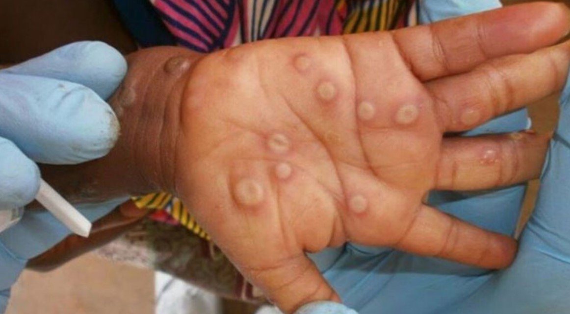 Xuất hiện đậu m&ugrave;a khỉ: Bộ Y tế chỉ đạo kh&ocirc;ng để l&acirc;y nhiễm ch&eacute;o   - Ảnh 1.