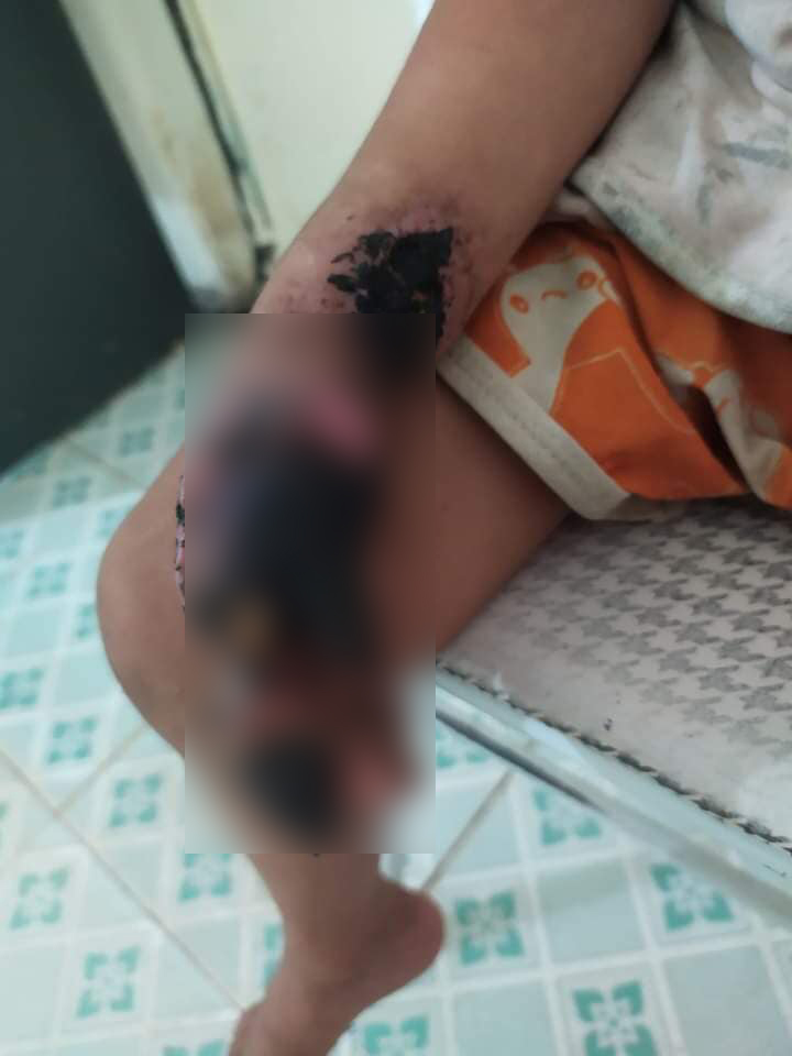 B&eacute; trai 3 tuổi nhập viện trong t&igrave;nh trạng chấn thương nặng b&agrave;n tay phải do bị điện giật - Ảnh 1.
