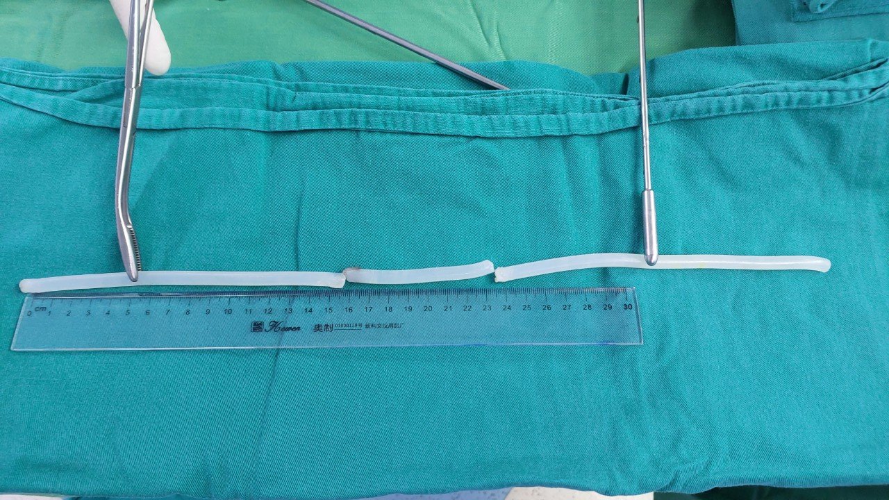 Cảnh báo rối loạn hành vi khi tự nhét dị vật vào niệu đạo- Ảnh 1. Cảnh báo rối loạn hành vi khi tự nhét dị vật vào niệu đạo- Ảnh 1.