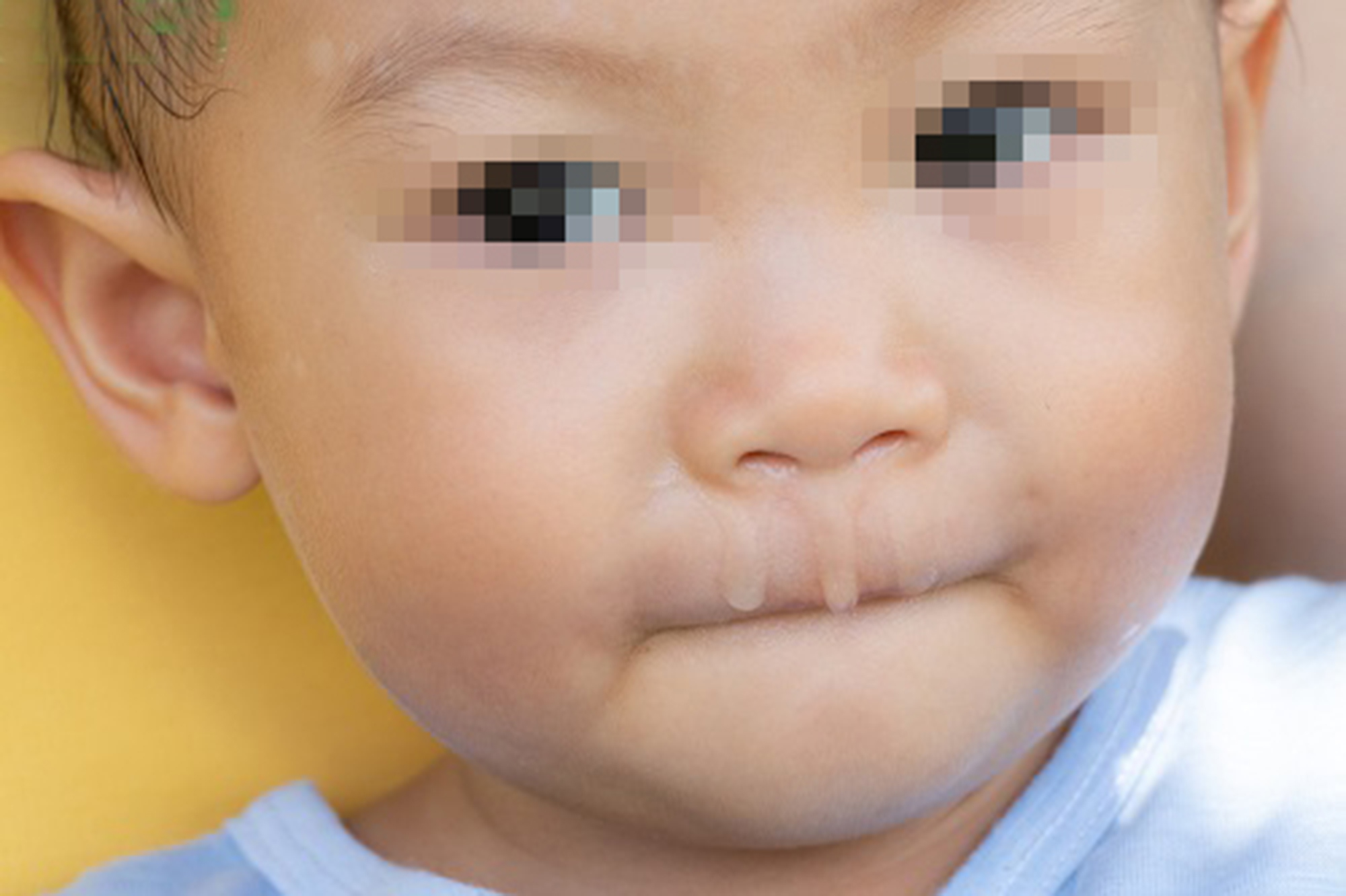 TRẺ NHỎ BỊ SỔ MŨI XANH CẦN ĐƯỢC THEO DÕI SÁT TÌNH TRẠNG SỨC KHỎE