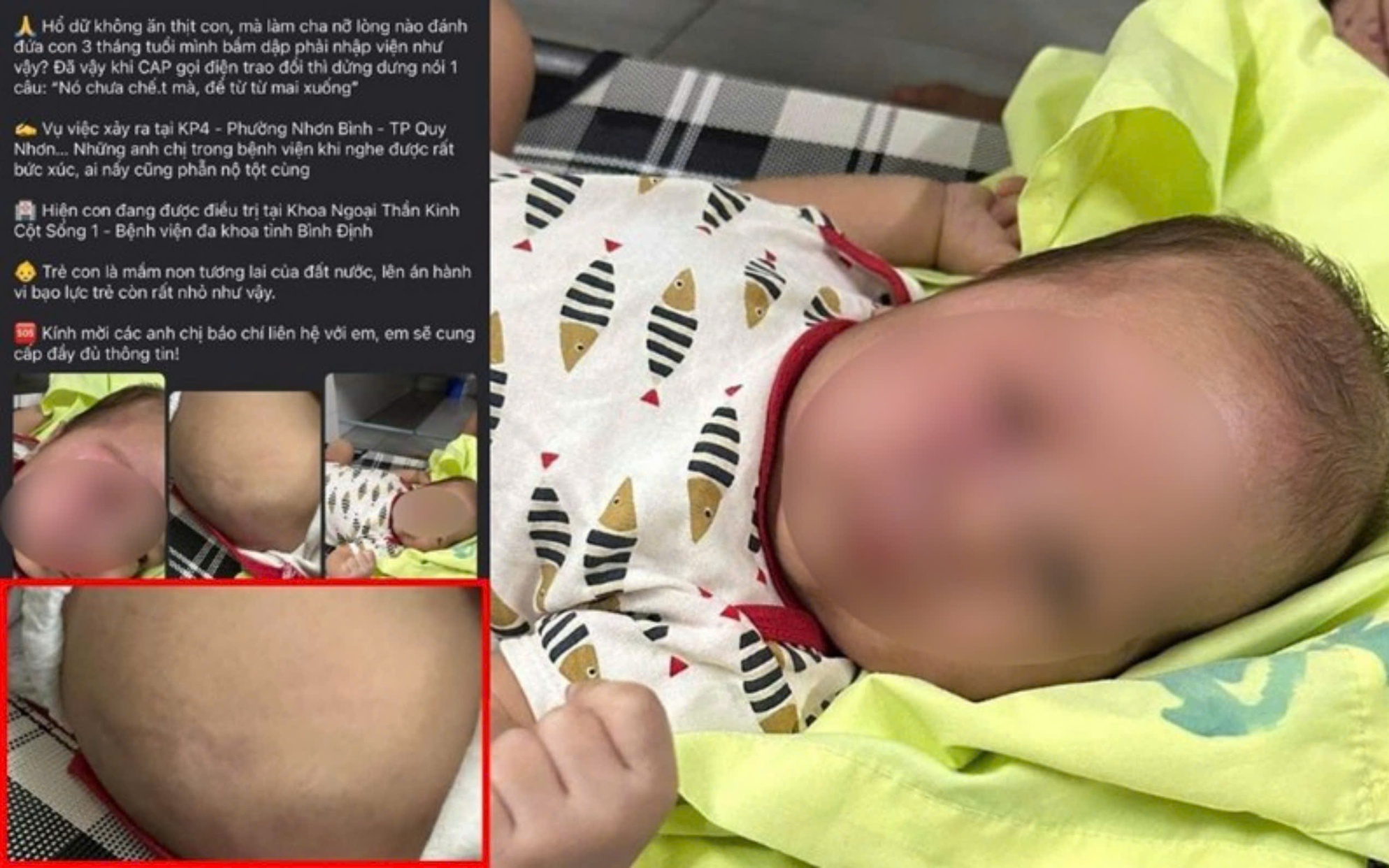 X&aacute;c minh vụ việc ch&aacute;u b&eacute; 3 th&aacute;ng tuổi nhập viện nghi bị bạo h&agrave;nh