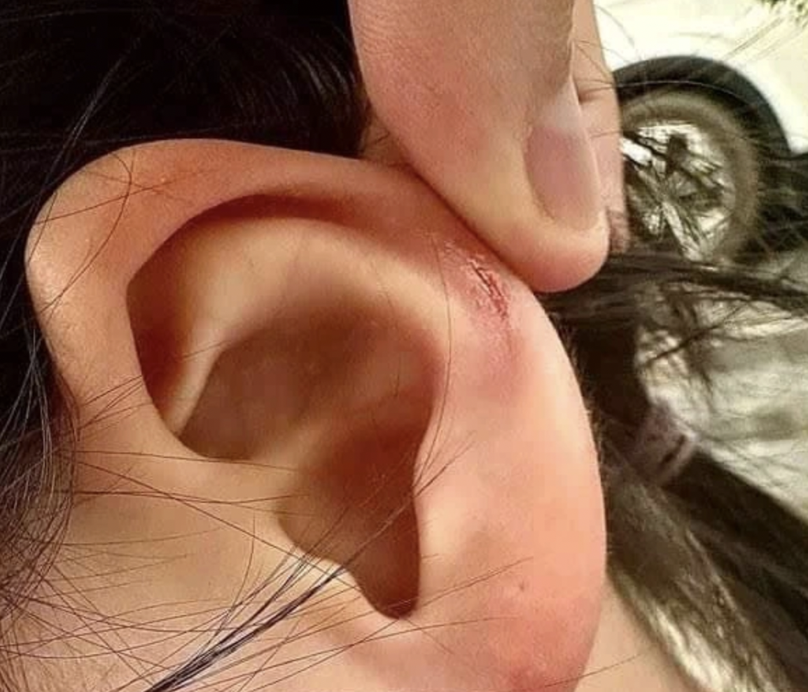 Vụ c&ocirc; gi&aacute;o đ&aacute;nh học sinh lớp 1 bầm t&iacute;m: Chuyển hồ sơ sang c&ocirc;ng an xử l&yacute;- Ảnh 3.