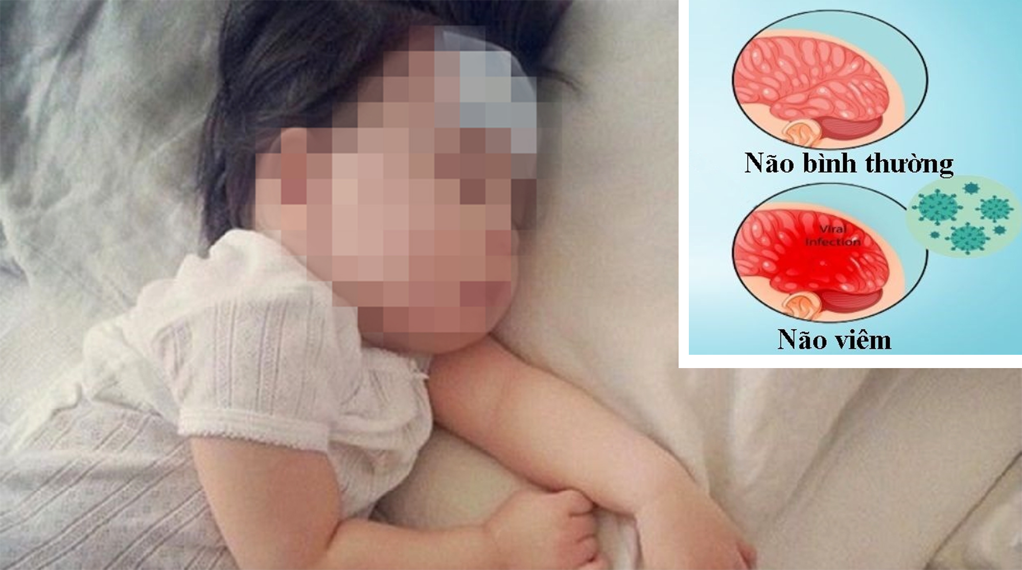 Dấu hiệu nhận biết vi&ecirc;m m&agrave;ng n&atilde;o ở trẻ em- Ảnh 1.