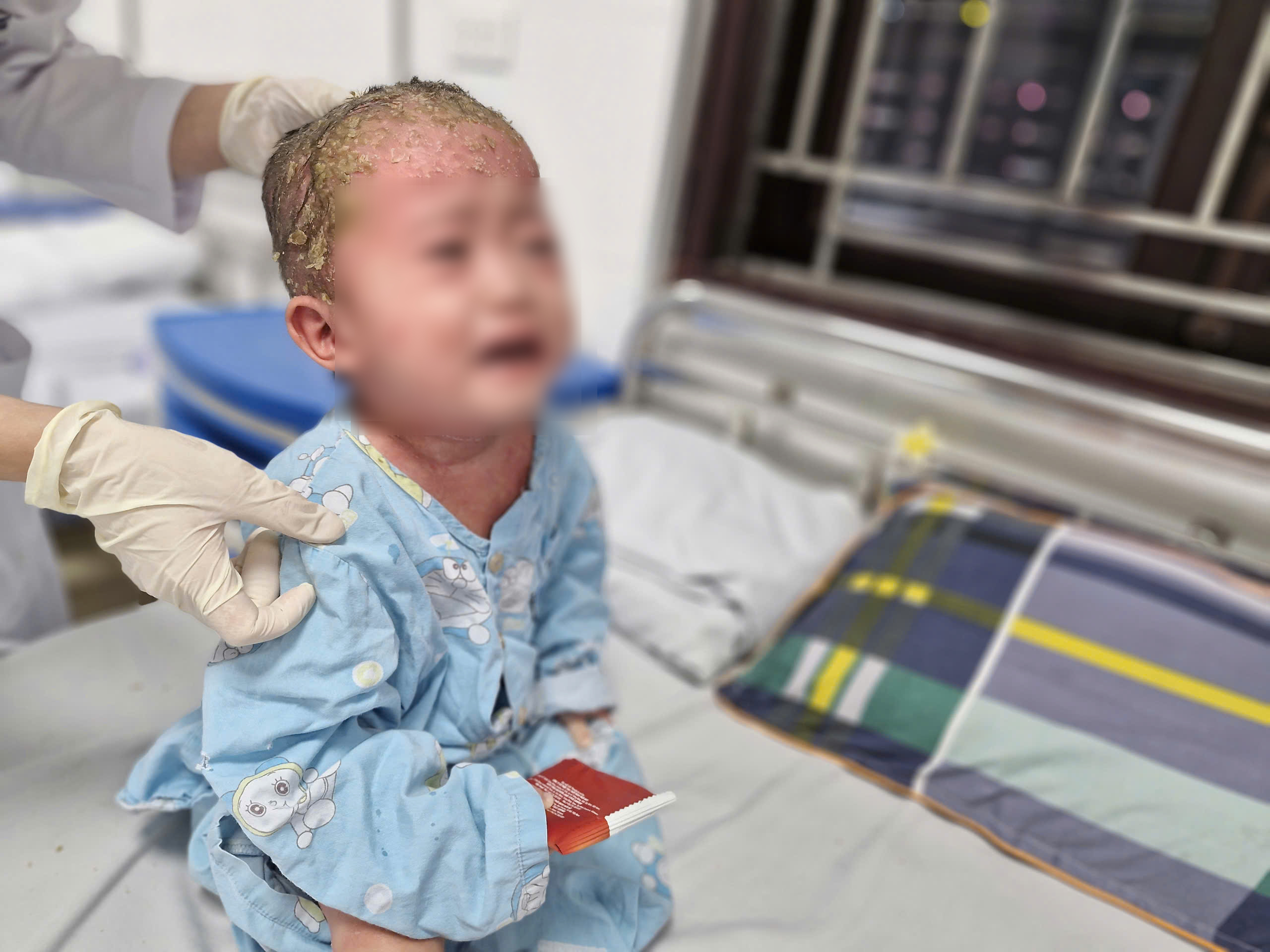 B&eacute; trai 2 tuổi trợt lo&eacute;t, chảy dịch khắp cơ thể do cha mẹ tự &yacute; l&agrave;m điều n&agrave;y- Ảnh 1.