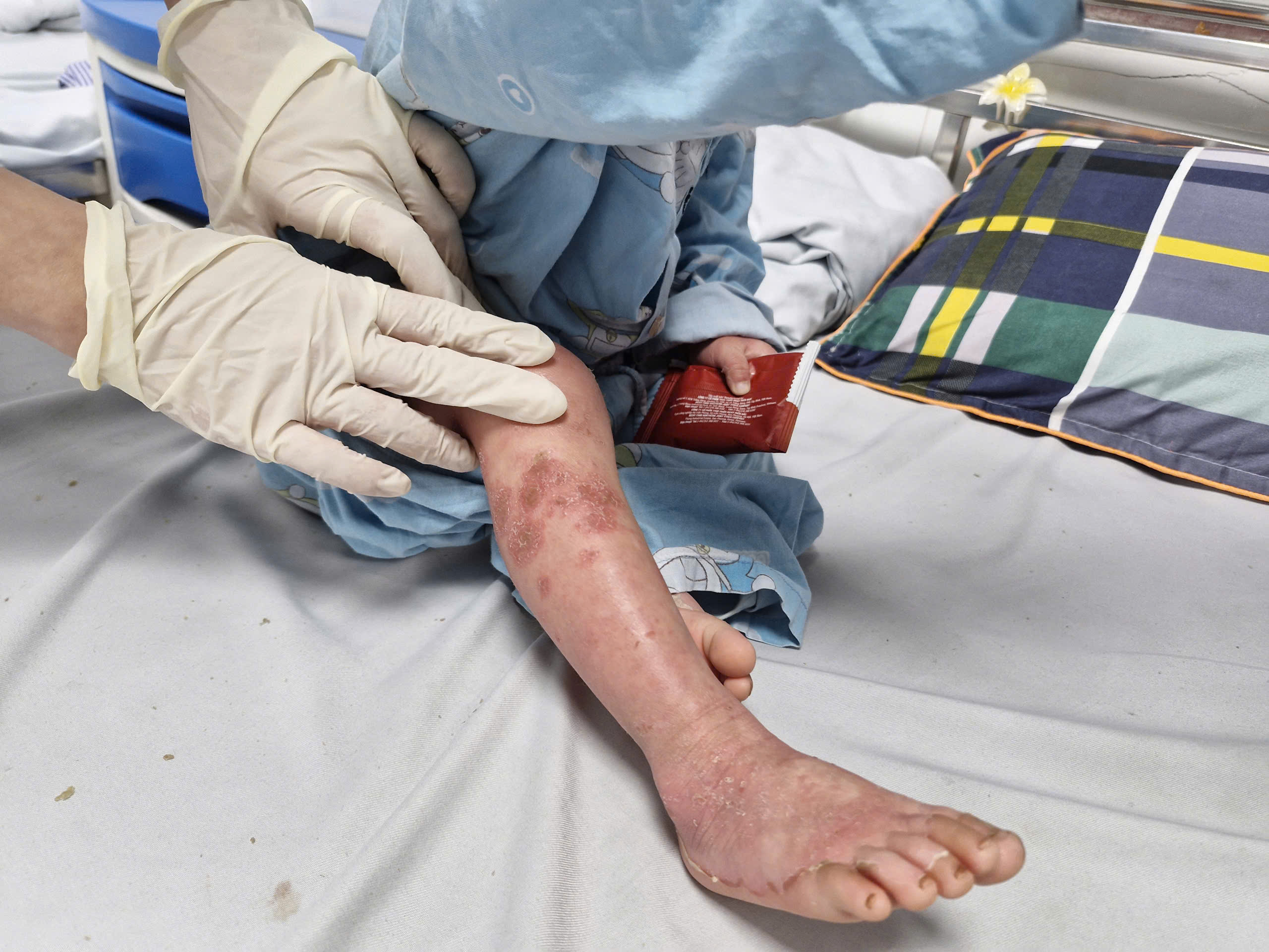 B&eacute; trai 2 tuổi trợt lo&eacute;t, chảy dịch khắp cơ thể do cha mẹ tự &yacute; l&agrave;m điều n&agrave;y- Ảnh 2.