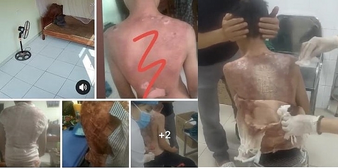 Điều tra vụ b&eacute; trai bỏng nặng nghi do mẹ kế hắt nước s&ocirc;i v&agrave;o người tại Vĩnh Ph&uacute;c- Ảnh 1.