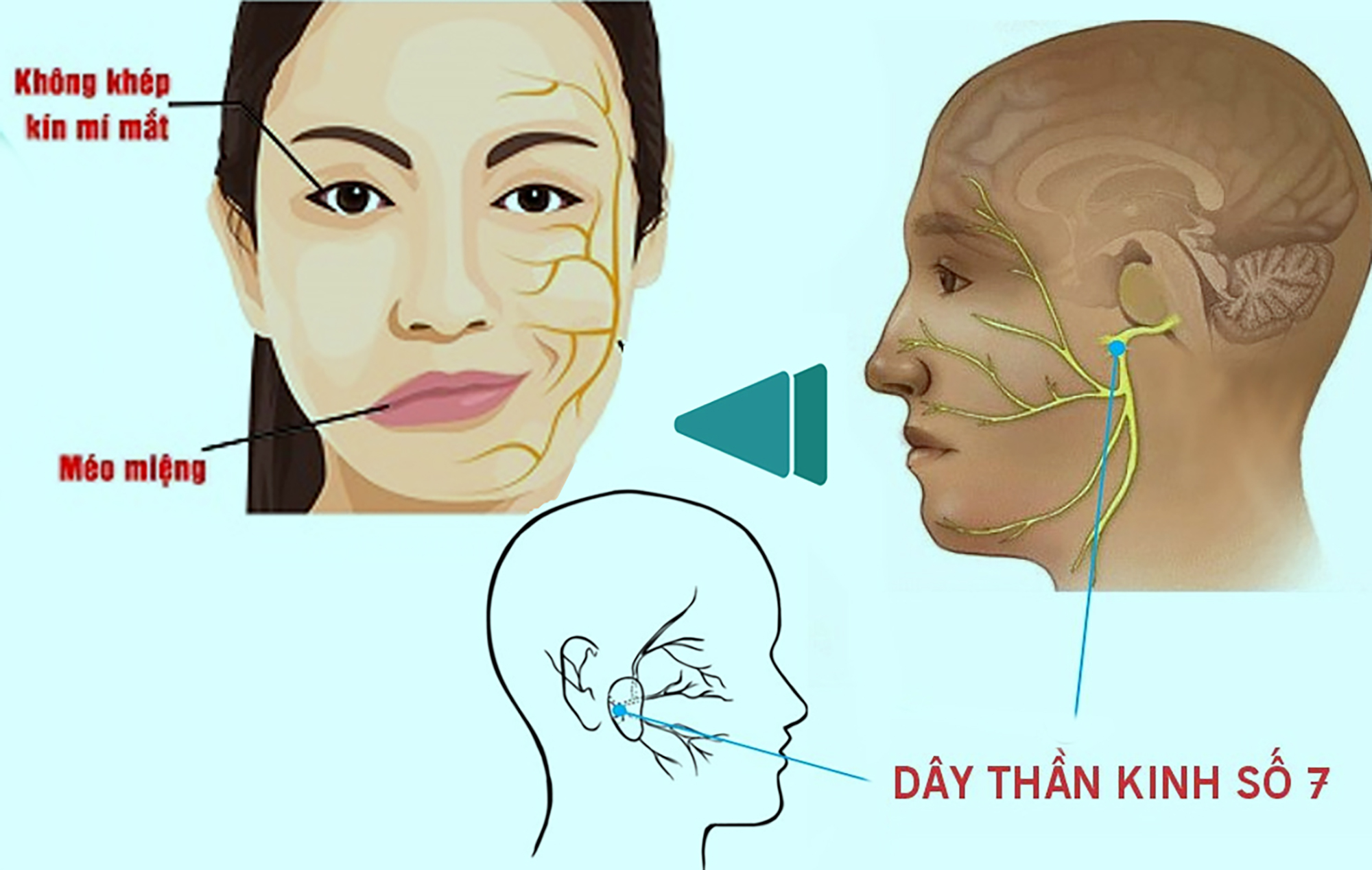 Liệt d&acirc;y thần kinh số 7 c&oacute; phục hồi được kh&ocirc;ng?- Ảnh 1.