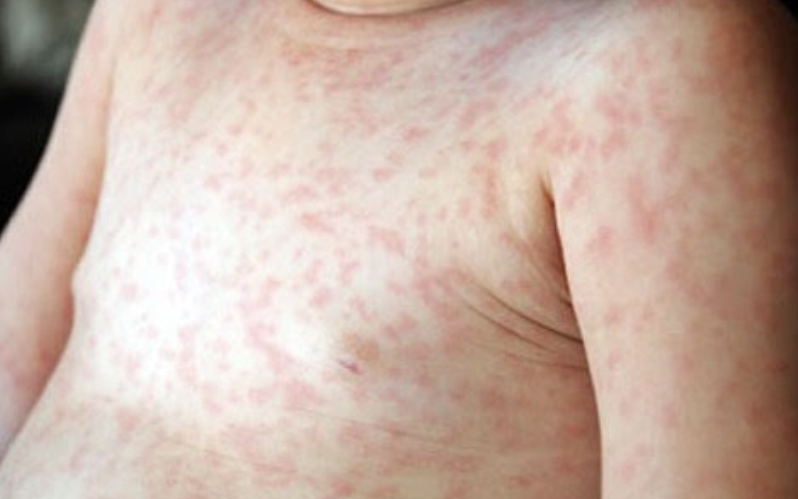 Đồng Nai ghi nhận ca tử vong đầu ti&ecirc;n do sởi