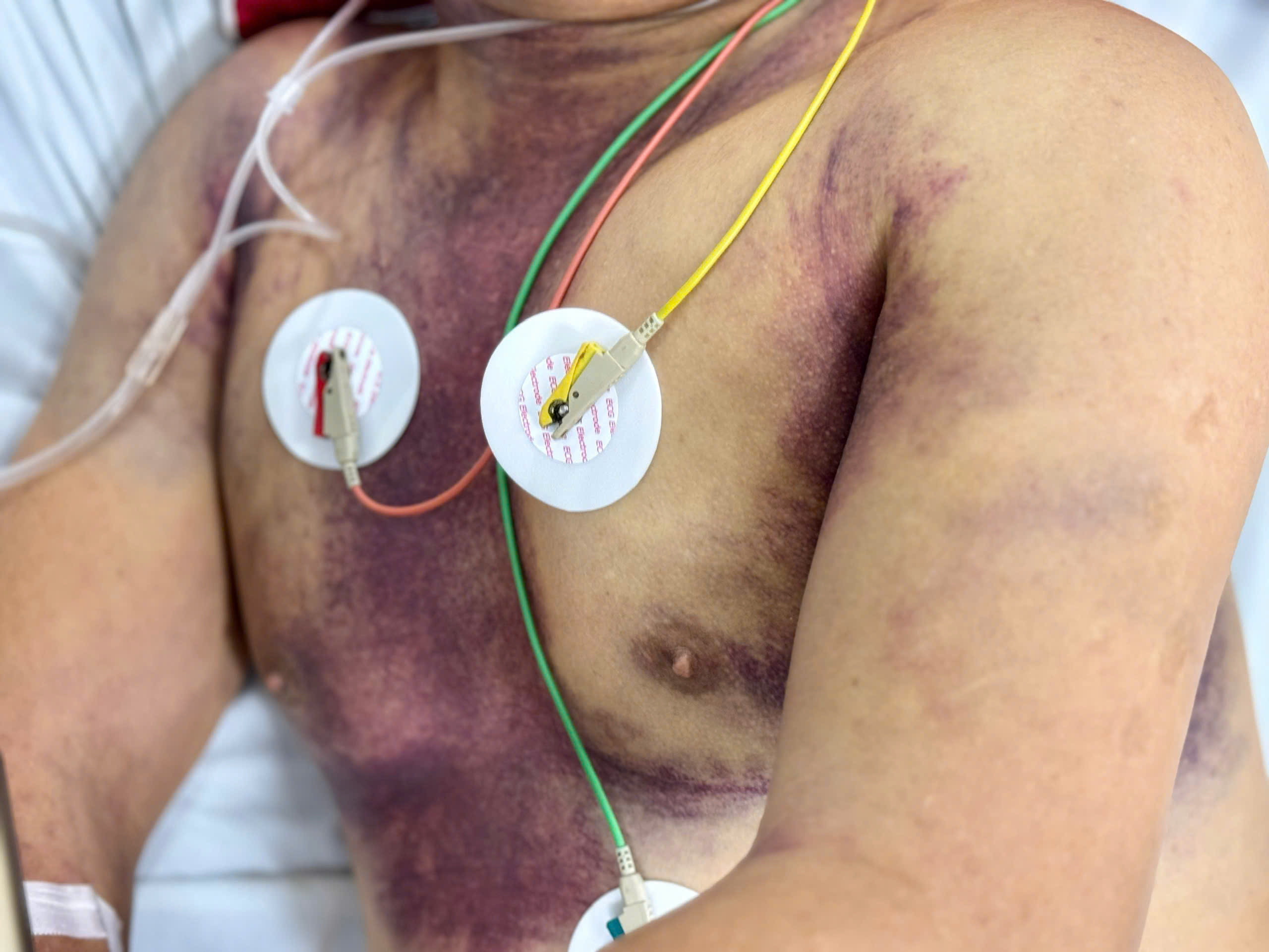 Cụ ông mất 1/2 lượng máu trong cơ thể do sốt xuất huyết- Ảnh 2. Cụ ông mất 1/2 lượng máu trong cơ thể do sốt xuất huyết- Ảnh 2.