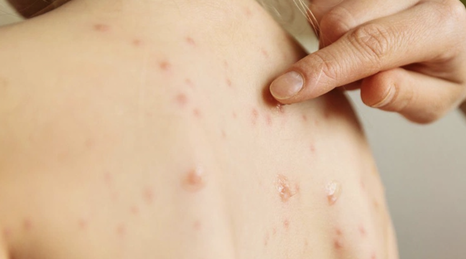 Nhiều người lớn ở Đồng Nai mắc sởi, một ca phải thở m&aacute;y v&agrave; lọc m&aacute;u- Ảnh 1.