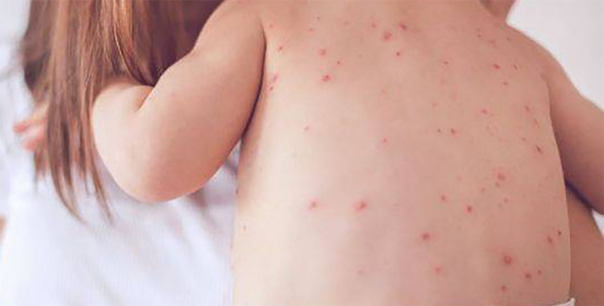 Trẻ bị sởi c&oacute; cần ki&ecirc;ng gi&oacute;, ki&ecirc;ng nước?- Ảnh 1.