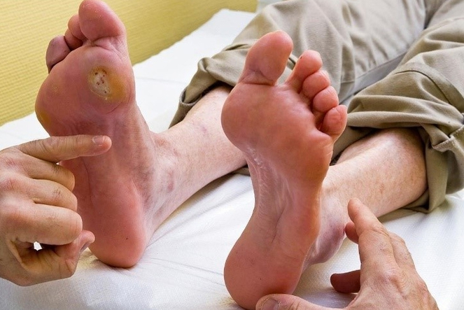 Biến chứng đ&aacute;i th&aacute;o đường c&oacute; nghi&ecirc;m trọng?- Ảnh 1.