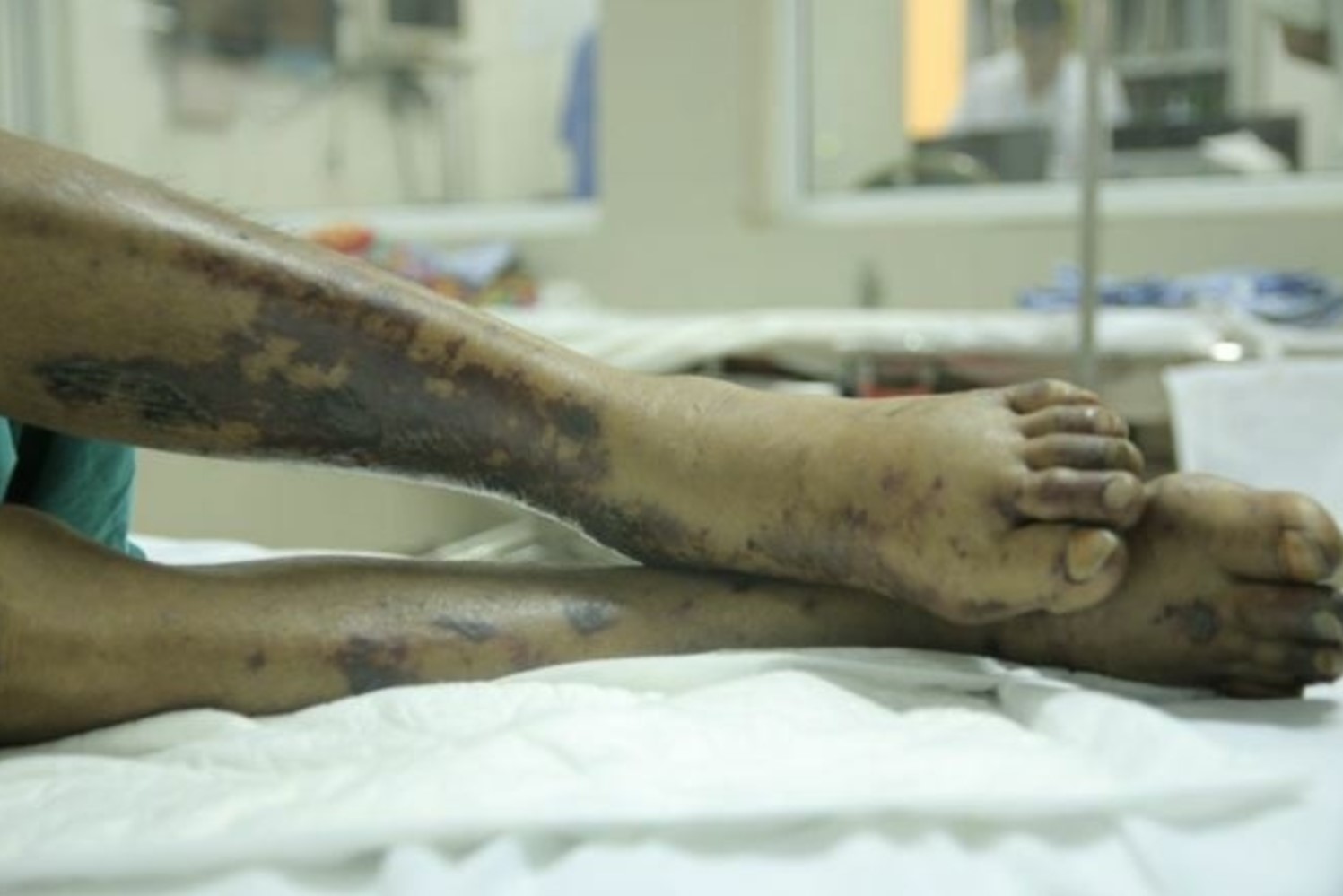 Mổ lợn chết, người đàn ông nguy kịch vì nhiễm liên cầu lợn- Ảnh 1. Mổ lợn chết, người đàn ông nguy kịch vì nhiễm liên cầu lợn- Ảnh 1.