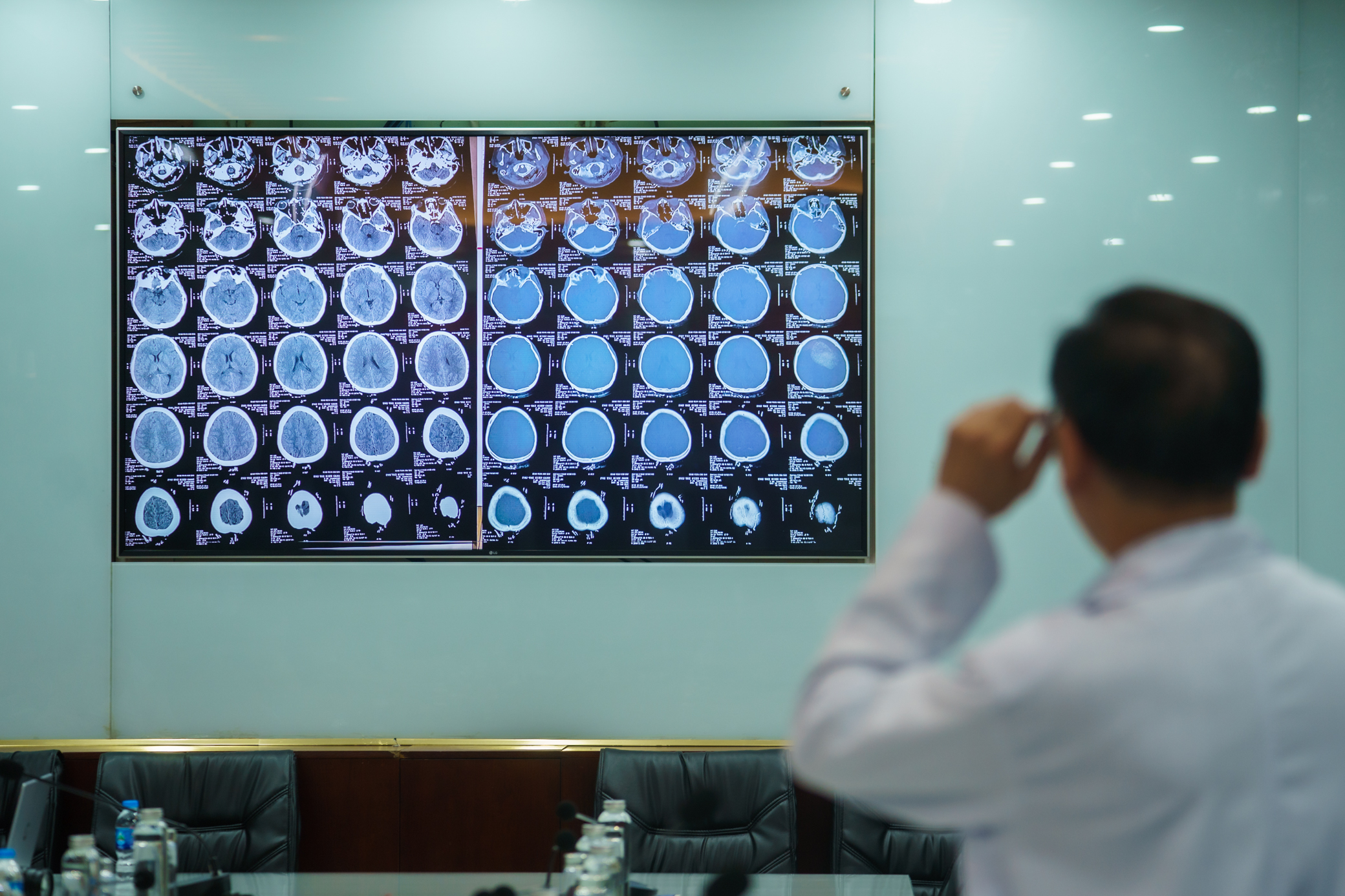 Nữ c&ocirc;ng nh&acirc;n bị m&aacute;y k&eacute;o sợi cuốn l&oacute;c to&agrave;n bộ da đầu- Ảnh 4.