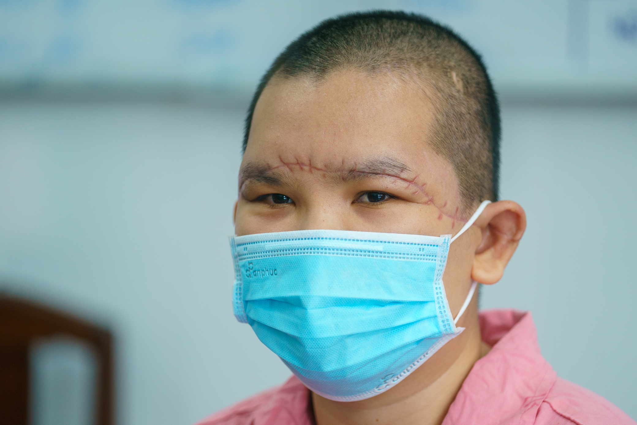 Nữ c&ocirc;ng nh&acirc;n bị m&aacute;y k&eacute;o sợi cuốn l&oacute;c to&agrave;n bộ da đầu- Ảnh 3.