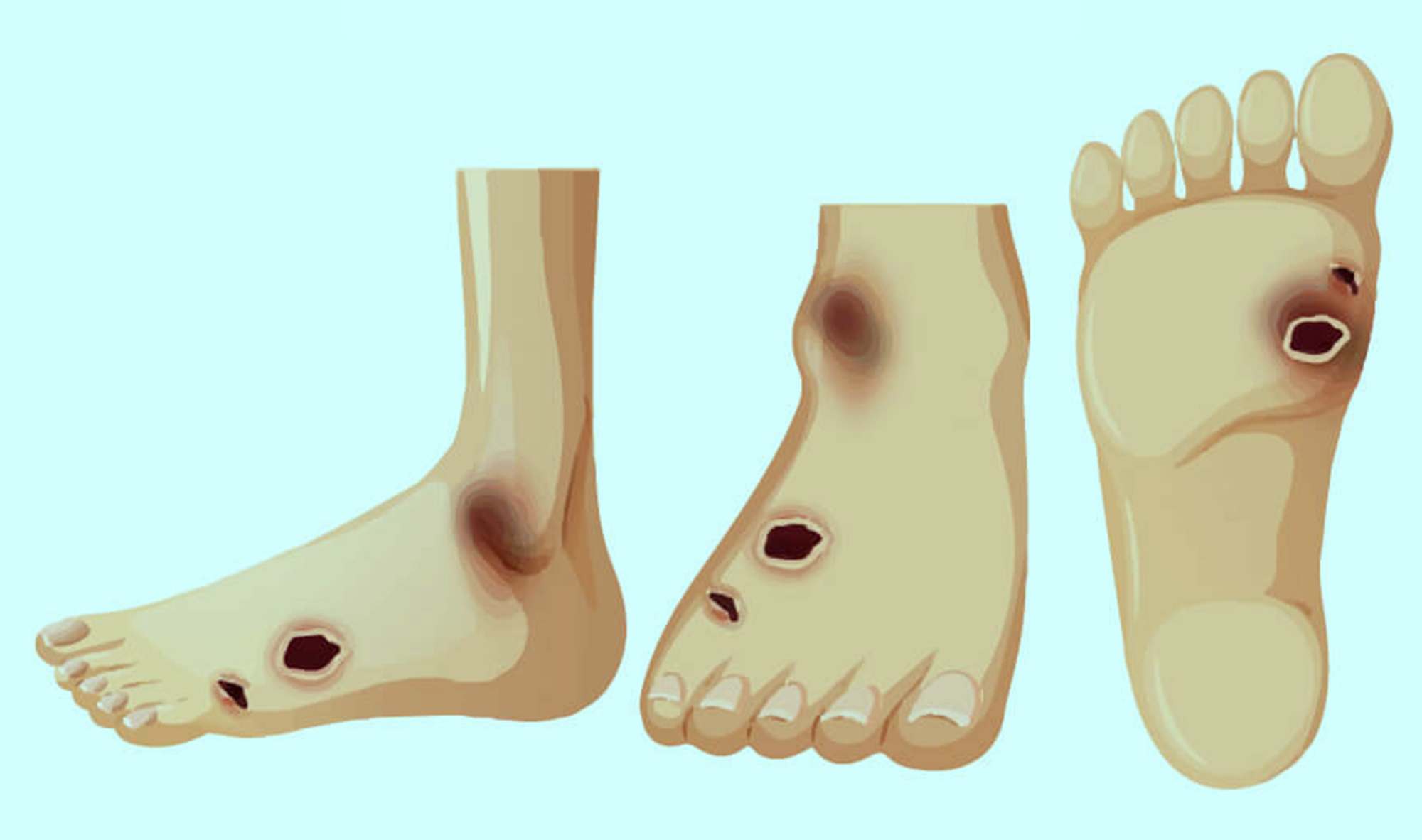 Tr&aacute;nh biến chứng b&agrave;n ch&acirc;n ở người mắc tiểu đường- Ảnh 1.