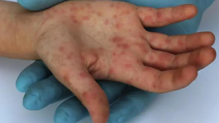 Một trường hợp nghi mắc bệnh đậu m&ugrave;a khỉ, Chủ tịch C&agrave; Mau chỉ đạo 