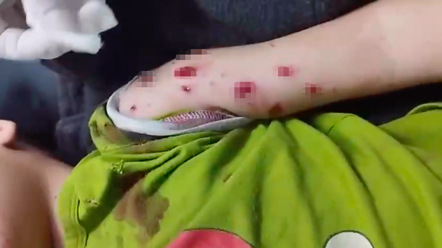 Nhặt &ldquo;vật lạ&rdquo; bị ph&aacute;t nổ, b&eacute; trai 4 tuổi nhập viện cấp cứu- Ảnh 1.