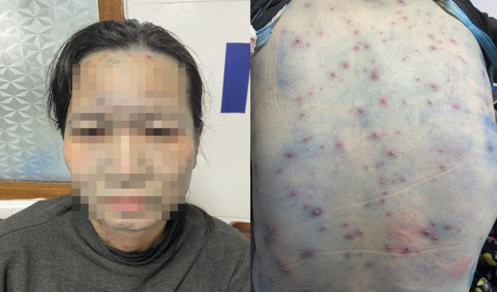 L&acirc;y nhiễm thủy đậu, nhiều bệnh nh&acirc;n đ&aacute;i th&aacute;o đường trở nặng- Ảnh 1.