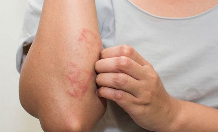 M&ugrave;a nồm ẩm, nhiều người bội nhiễm v&igrave; ngứa ng&aacute;y- Ảnh 1.