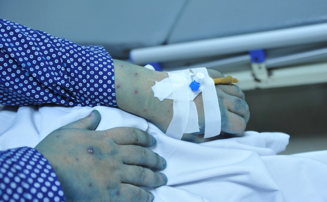 Nhiều bệnh nhân thủy đậu và ho gà nhập viện vì biến chứng- Ảnh 1. Nhiều bệnh nhân thủy đậu và ho gà nhập viện vì biến chứng- Ảnh 1.