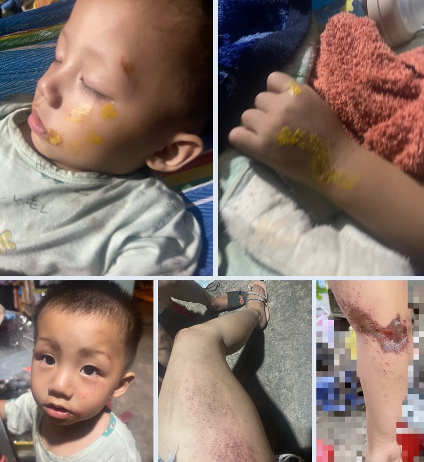 Bị t&ecirc;n cướp giật t&uacute;i x&aacute;ch trong đ&ecirc;m, mẹ v&agrave; con trai 18 th&aacute;ng ng&atilde; nh&agrave;o xuống đường- Ảnh 1.