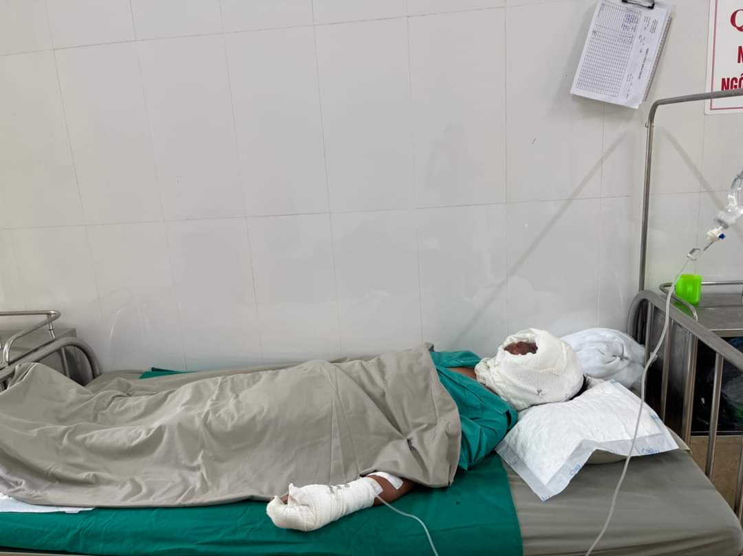 R&ograve; rỉ b&igrave;nh gas ở Y&ecirc;n B&aacute;i, 4 người trong gia đ&igrave;nh bỏng nặng- Ảnh 2.