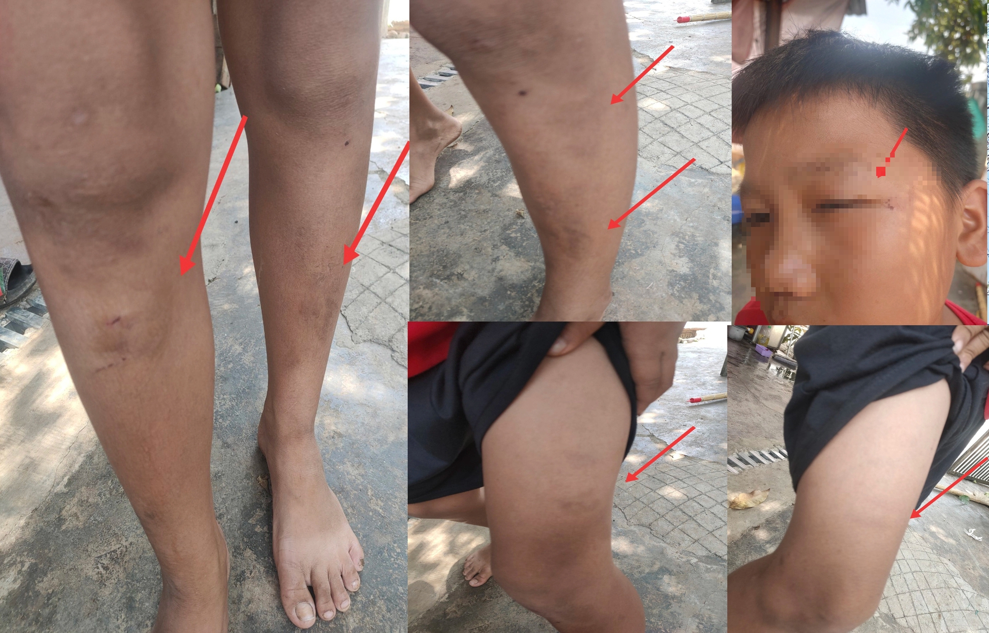 Chuyển hồ sơ c&ocirc;ng an điều tra vụ 5 đứa trẻ bị người phụ nữ đ&aacute;nh bầm dập- Ảnh 1.