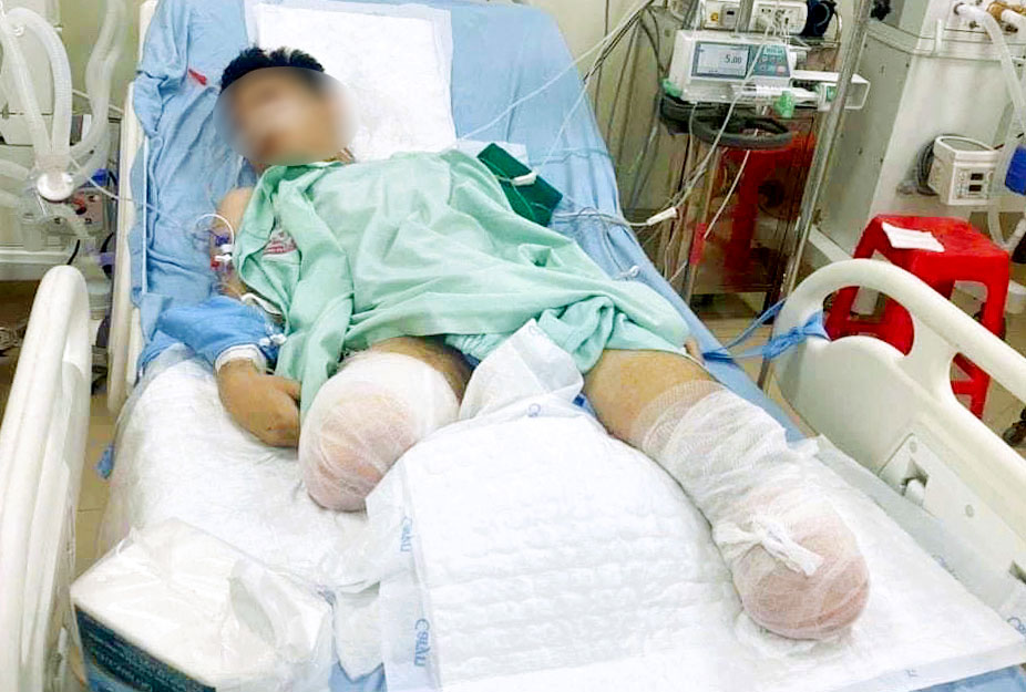 Nam sinh Vĩnh Ph&uacute;c bị tai nạn mất đ&ocirc;i ch&acirc;n được x&eacute;t đặc c&aacute;ch tốt nghiệp THPT- Ảnh 1.