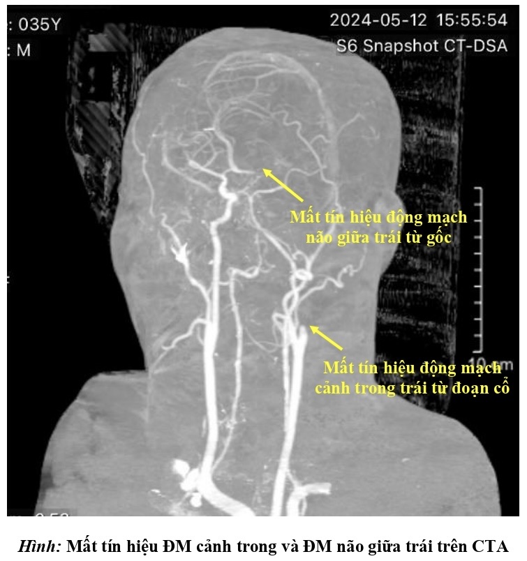 Người đ&agrave;n &ocirc;ng đột quỵ sau khi gi&aacute;c hơi chữa đau lưng, đau vai g&aacute;y tại nh&agrave;- Ảnh 3.