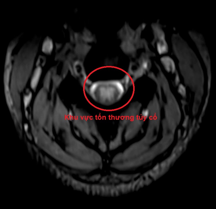 Nữ sinh liệt 2 ch&acirc;n sau khi h&iacute;t 15 quả b&oacute;ng cười- Ảnh 2.