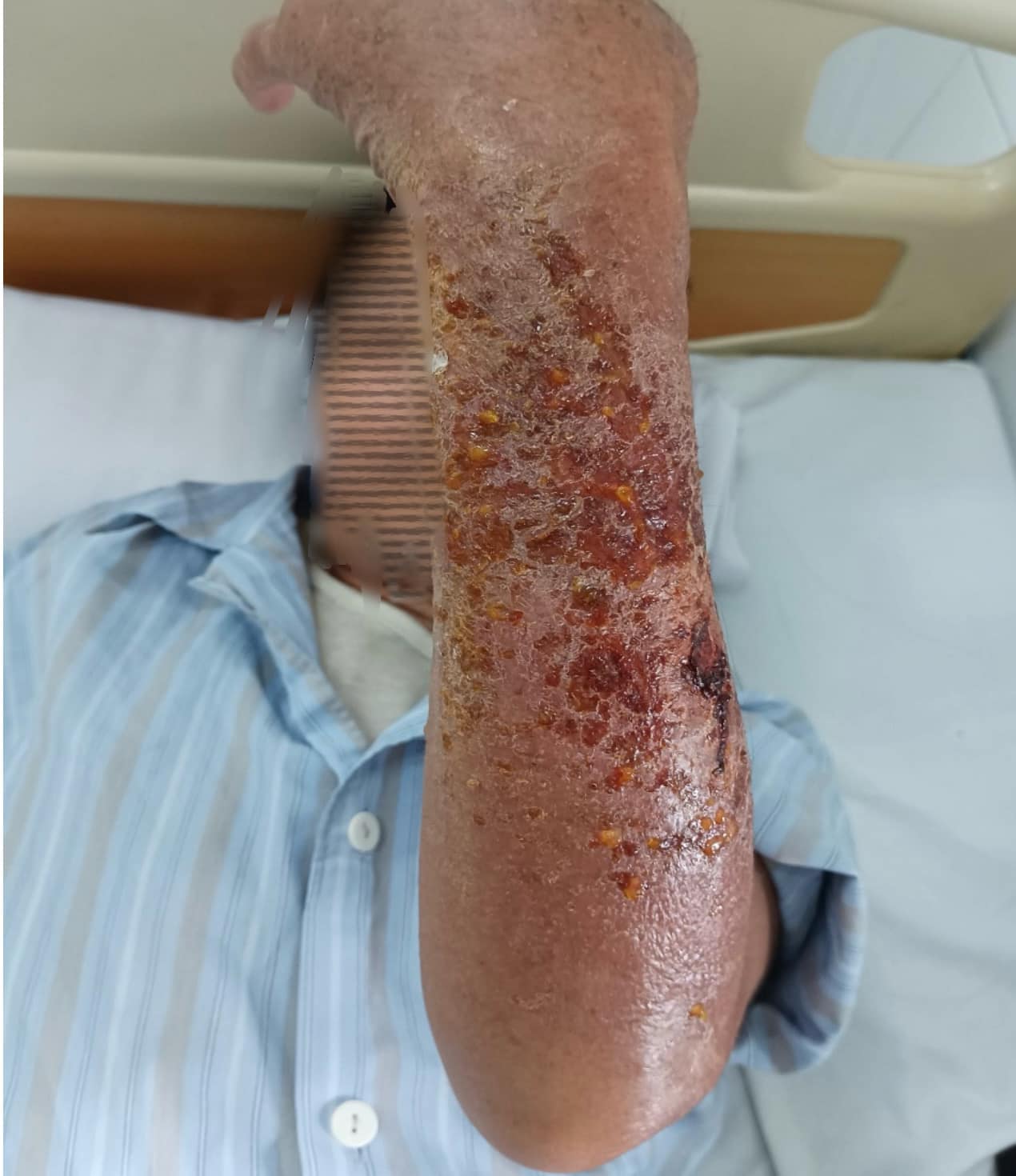 Nhiều người bị chảy dịch, ph&ugrave; nề đau nhức v&igrave; vết xước nhỏ do ch&oacute; cắn, m&egrave;o c&agrave;o- Ảnh 1.