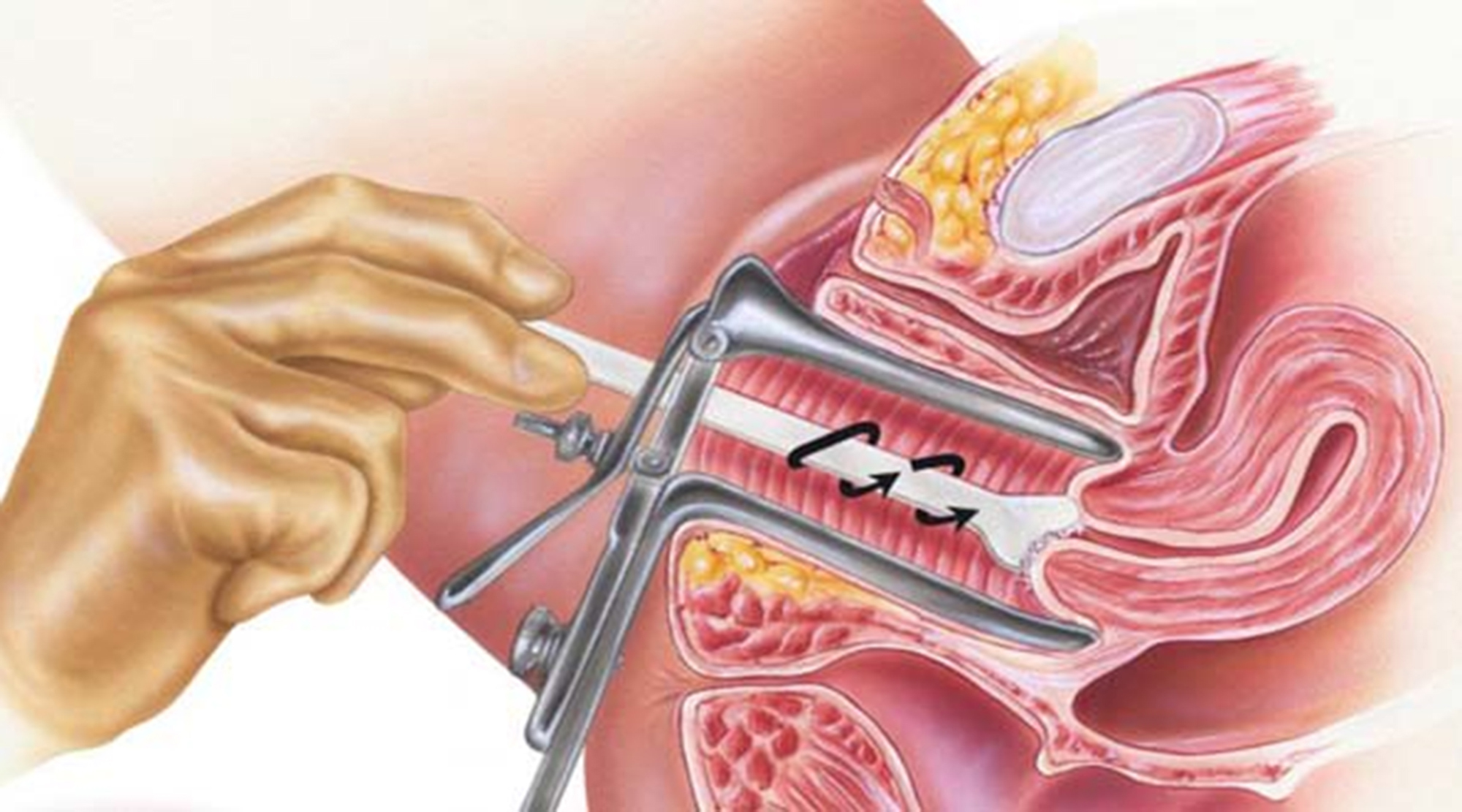 Ung thư cổ tử cung có thể tầm soát sớm?- Ảnh 1.