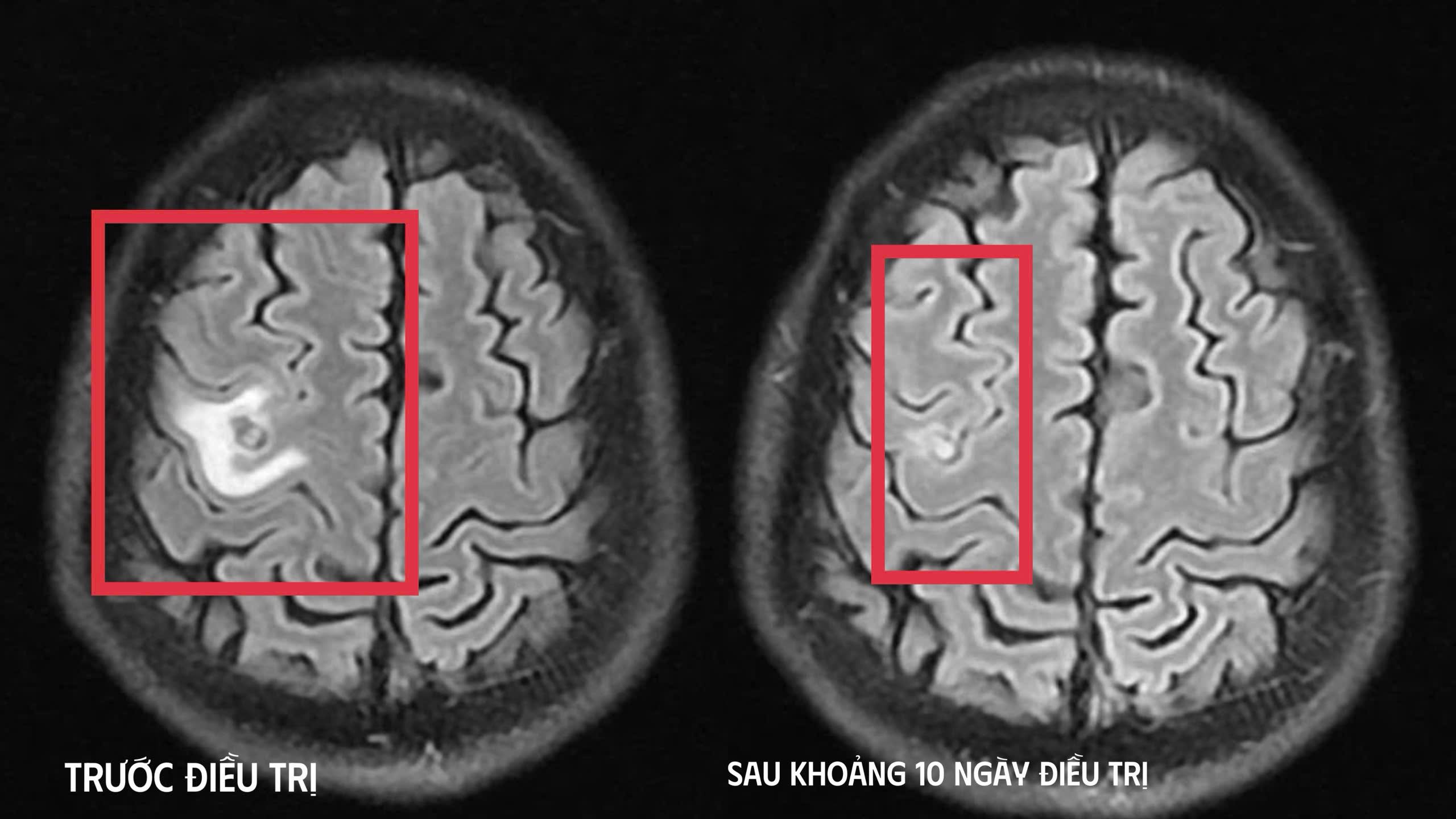 Co giật do s&aacute;n n&atilde;o, nam trung ni&ecirc;n cứ ngỡ mắc u n&atilde;o- Ảnh 2.
