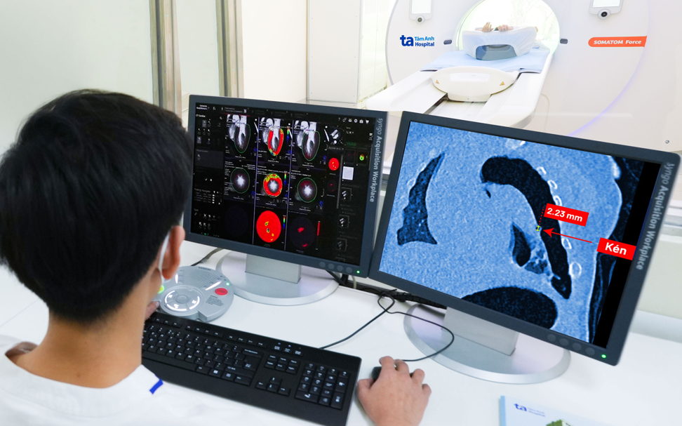 Việt Nam lần đầu ti&ecirc;n sở hữu &ldquo;si&ecirc;u m&aacute;y chụp CT thế hệ mới&rdquo; với số l&aacute;t cắt cực đại- Ảnh 4.