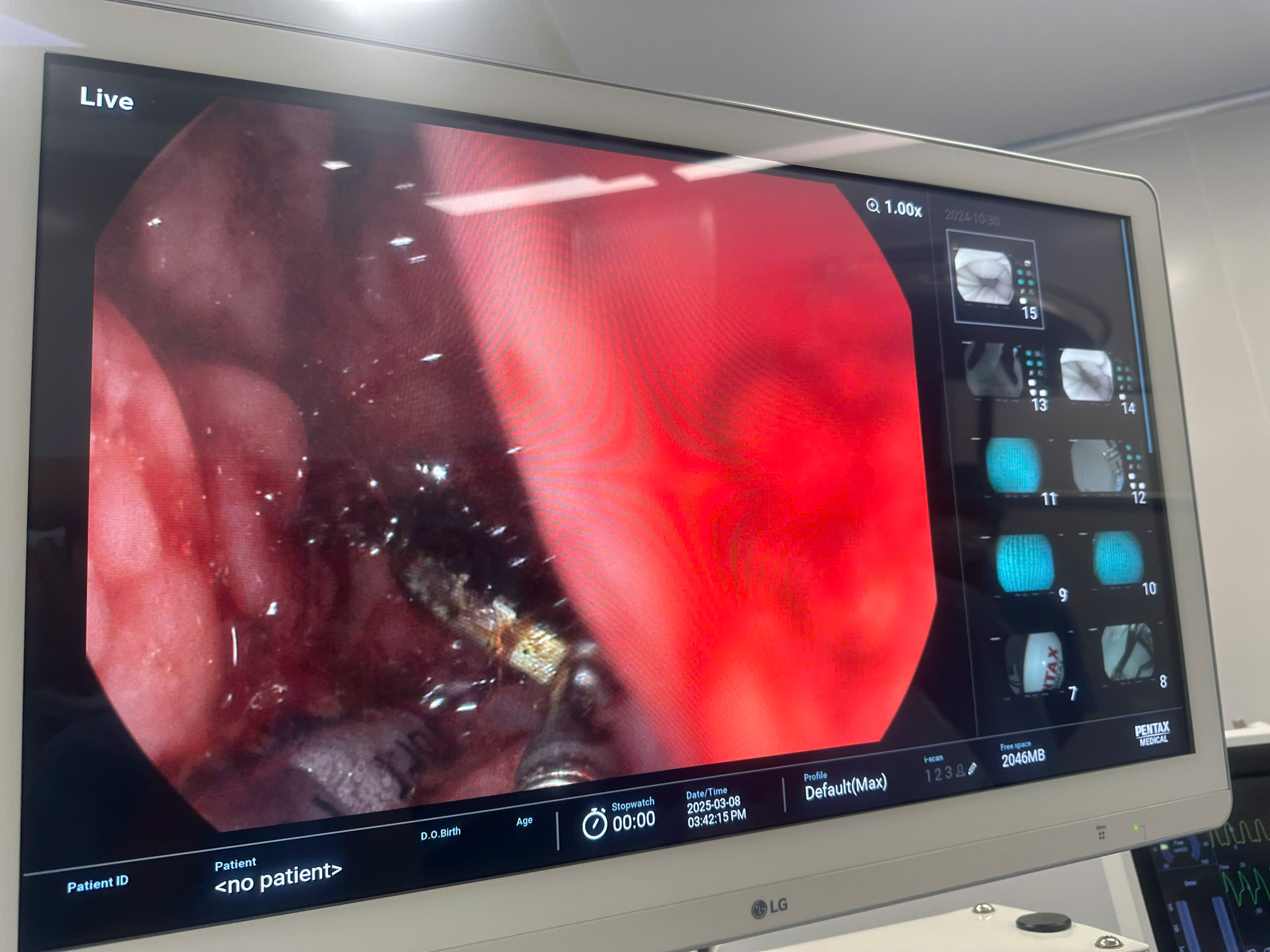 Trẻ su&yacute;t thủng thực quản, gi&agrave; &aacute;p xe gan nguy kịch v&igrave; h&oacute;c dị vật- Ảnh 4.