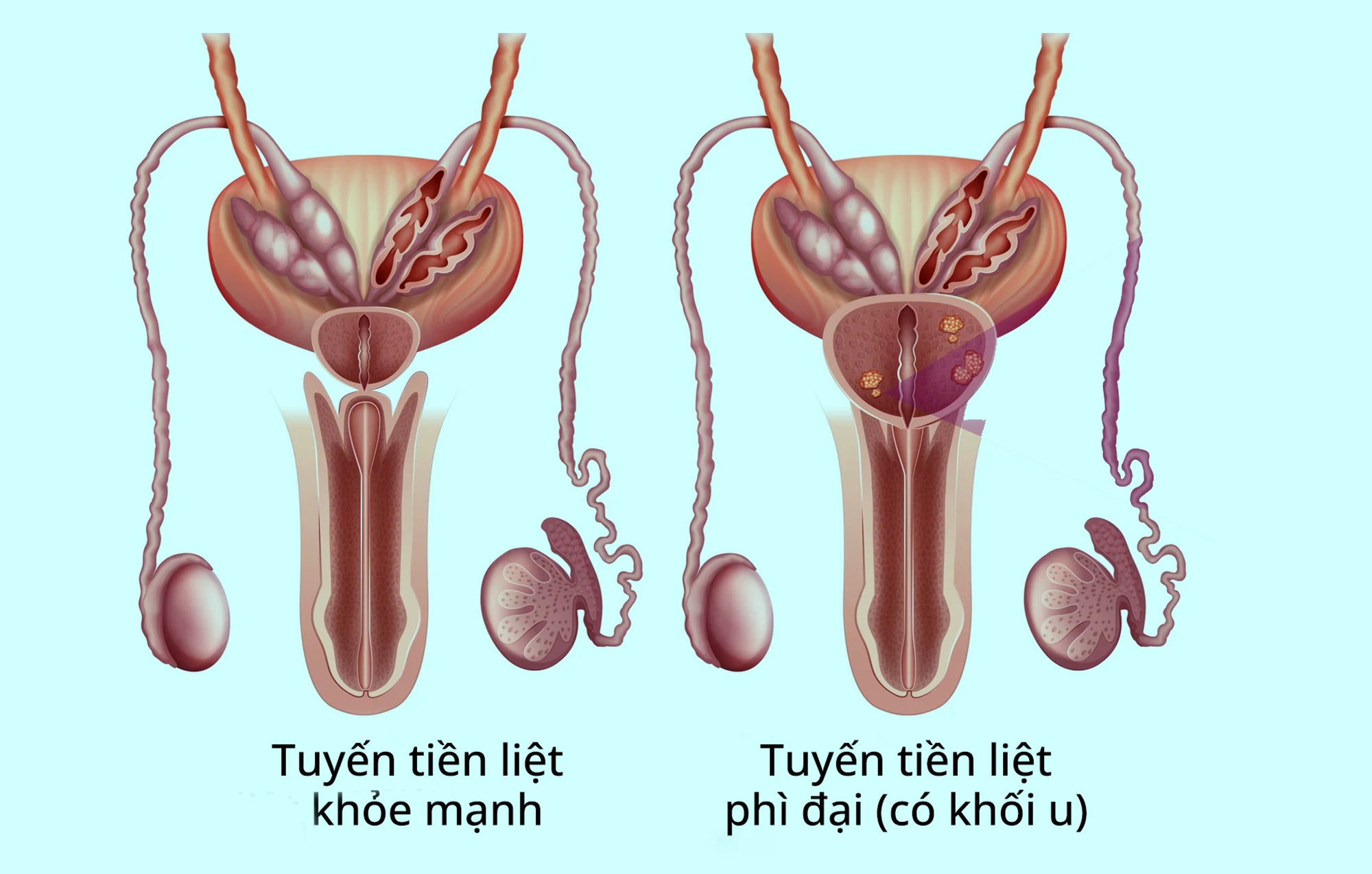 Ph&igrave; đại tuyến tiền liệt c&oacute; cần phẫu thuật?- Ảnh 1.