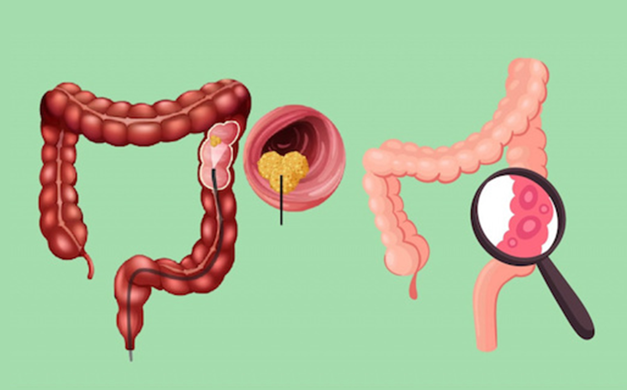Cách nào để kiểm soát ung thư đại tràng?- Ảnh 1. Cách nào để kiểm soát ung thư đại tràng?- Ảnh 1.