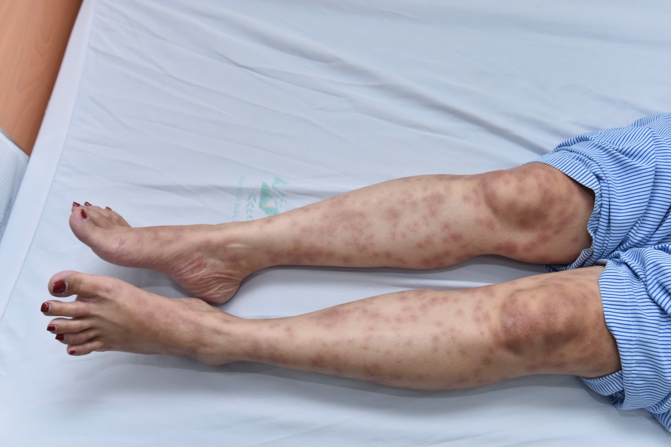 Người phụ nữ nguy kịch sau khi d&ugrave;ng thuốc giảm c&acirc;n thải độc, collagen kh&ocirc;ng r&otilde; nguồn gốc- Ảnh 2.