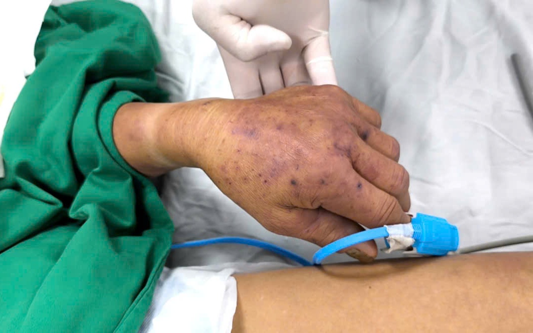 Sở Y tế Hưng Yên xác minh vụ việc 2 người tử vong sau khi ăn tiết canh, lòng lợn- Ảnh 2. Cụ ông nguy kịch vì nhiễm liên cầu lợn sau 3 ngày ăn tiết canh