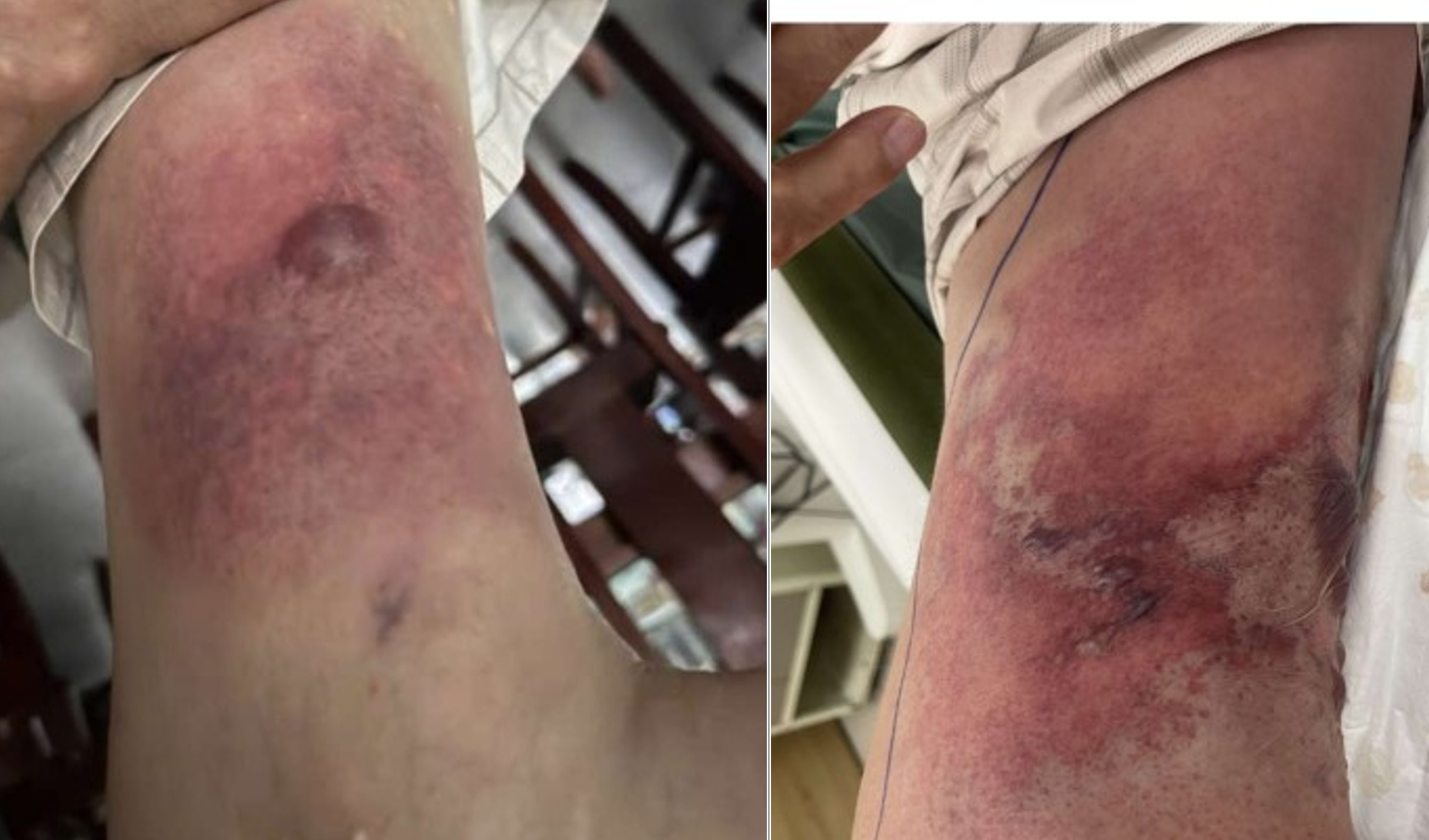 Chủ quan với vết thương nhỏ khi tắm biển, nam trung ni&ecirc;n su&yacute;t mất mạng- Ảnh 2.