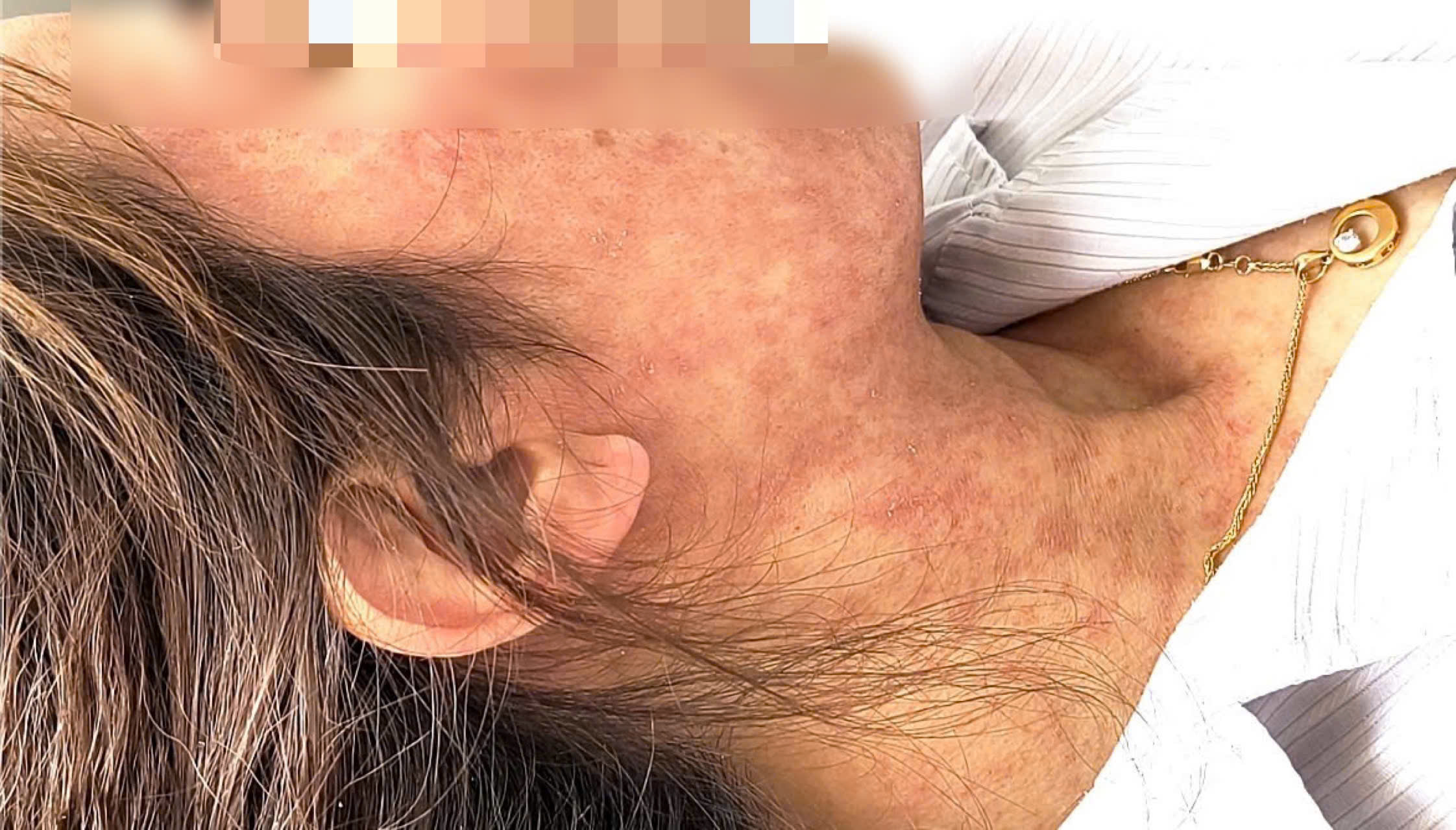 Chủ quan với bệnh sởi "trẻ em", người lớn gặp biến chứng- Ảnh 2. Chủ quan với bệnh sởi "trẻ em", người lớn gặp biến chứng- Ảnh 2.