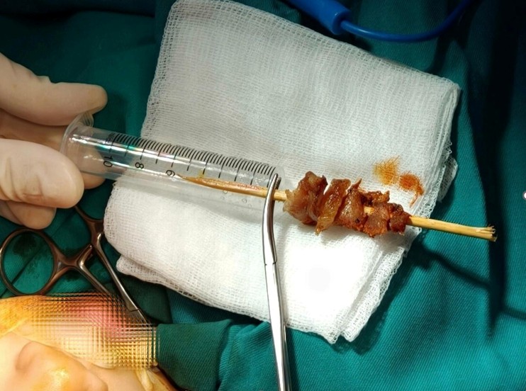 B&eacute; g&aacute;i 2,5 tuổi bị que xi&ecirc;n thịt đ&acirc;m s&acirc;u nguy cơ xuy&ecirc;n sọ n&atilde;o- Ảnh 1.