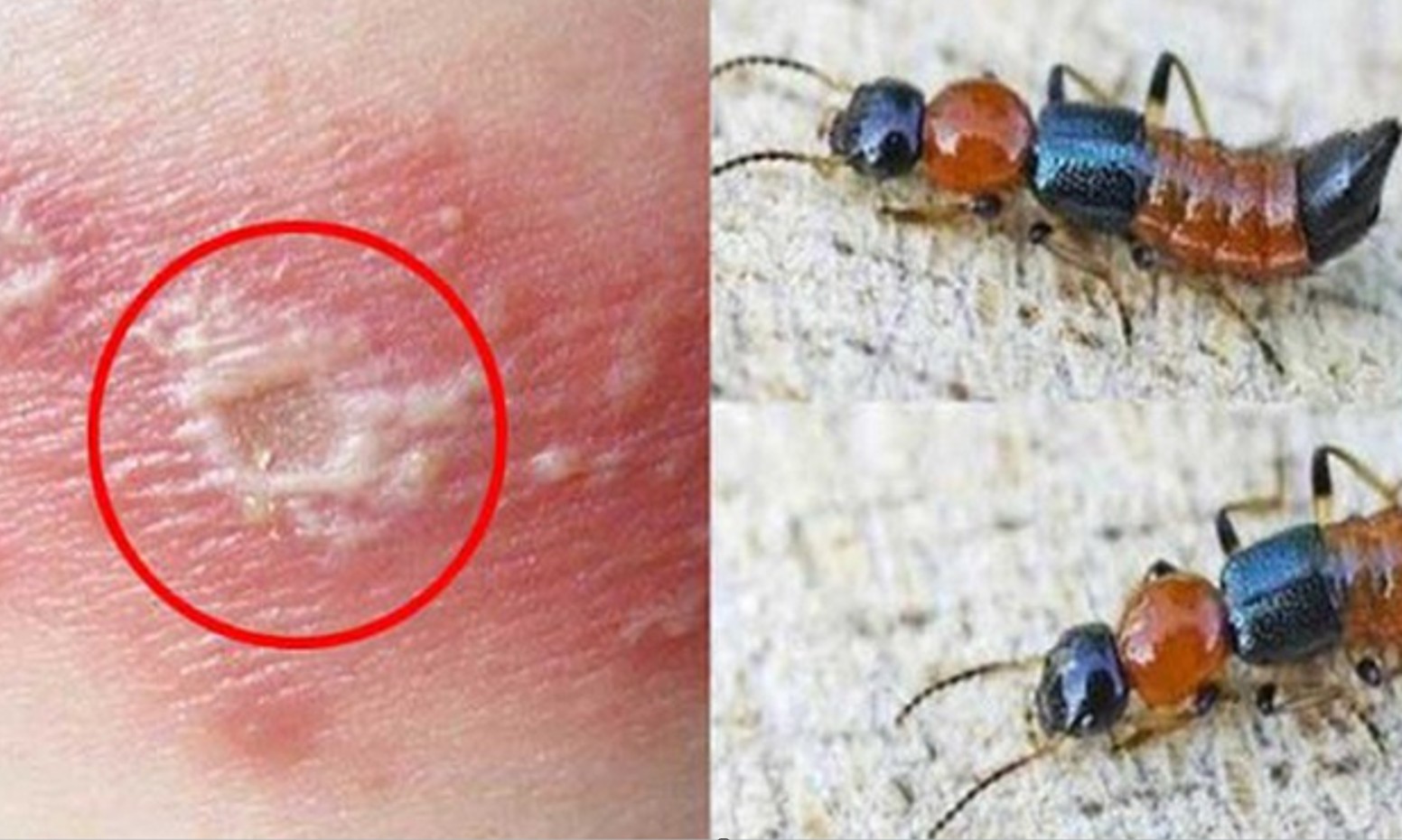B&aacute;c sĩ cảnh b&aacute;o kh&ocirc;ng chủ quan với tổn thương do kiến ba khoang g&acirc;y ra- Ảnh 1.