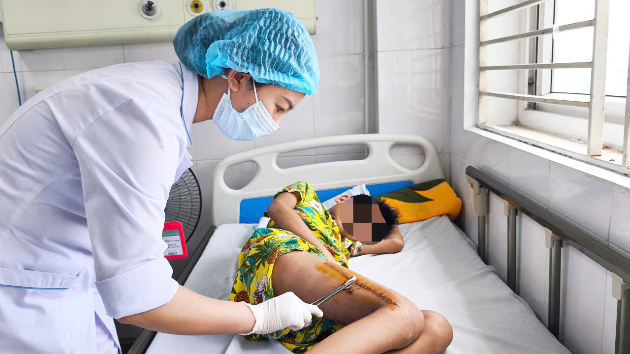 B&eacute; trai 11 tuổi su&yacute;t mất ch&acirc;n v&igrave; tụ cầu v&agrave;ng tấn c&ocirc;ng xương đ&ugrave;i - Ảnh 2.