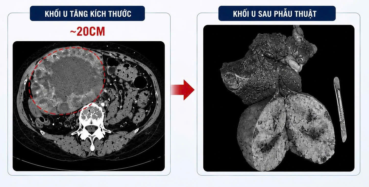 Tự &yacute; uống thuốc nam, một phụ nữ nhập viện với khối u gan 20cm- Ảnh 2.